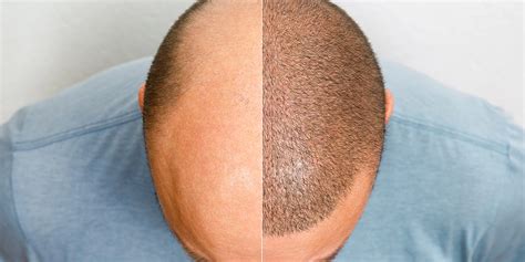Scalp Micropigmentation: Cost, Benefits & More .